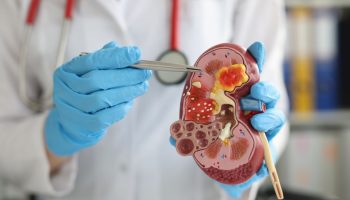 Día Mundial del Cáncer de Riñón: avances en prevención, diagnóstico y tratamiento