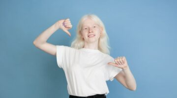 Día de sensibilización sobre el albinismo ABC sobre este trastorno fOTO FREEPIK