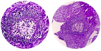 Efectividad de la inteligencia artificial en el diagnóstico del biomarcador del cáncer colorrectal