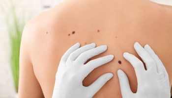 El principal obstáculo para la detección de un melanoma está entre el primer y segundo nivel de atención Dra. Paola Cárdenas