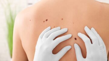 El principal obstáculo para la detección de un melanoma está entre el primer y segundo nivel de atención Dra. Paola Cárdenas