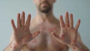 En 2 de 5 casos de viruela símica, los pacientes son VIH positivo