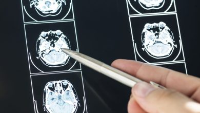 Epilepsia colombia trastorno invisible