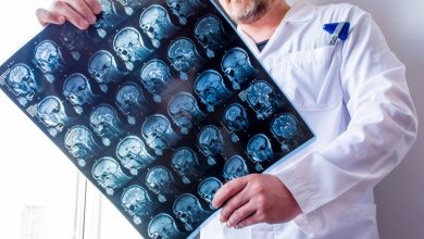 Epilepsia focal Mapeo de lesiones podría mejorar diagnósticos y tratamiento