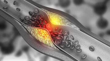 EsSalud adquirirá “stent” para la atención de pacientes con accidentes cerebrovasculares