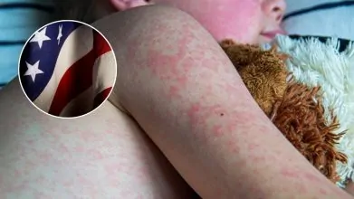 Estados Unidos enfrenta una crisis de salud pública con más de 1.000 casos de sarampión y brotes activos en 11 estados
