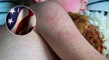 Estados Unidos enfrenta una crisis de salud pública con más de 1.000 casos de sarampión y brotes activos en 11 estados