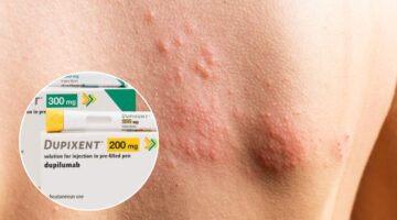 FDA aprueba Dupixent para urticaria crónica espontánea: Sanofi y Regeneron logran séptima indicación del biológico