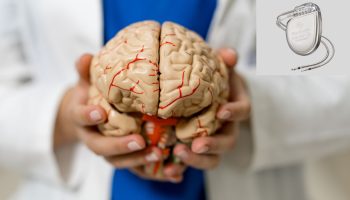 FDA aprueba terapia DBS adaptativa en párkinson