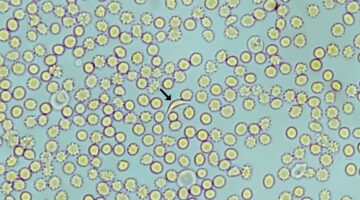 FDA aprueba terapias génicas para anemia de células falciformes - Avance revolucionario