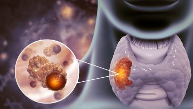 Firma molecular que predice el cáncer de tiroides agresivo