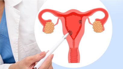 Grupo de fármacos pueden ralentizar el progreso del cáncer de útero agresivo