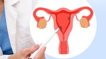 Grupo de fármacos pueden ralentizar el progreso del cáncer de útero agresivo