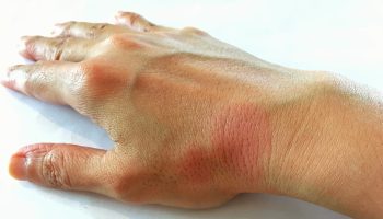 Hallan la causa genética del lupus