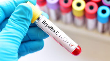 Hepatitis C: Síntomas, causas, diagnóstico y tratamiento