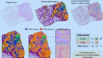 IA revoluciona el diagnóstico de cáncer de pulmón