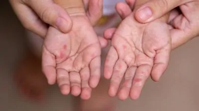 INS refuerza vigilancia ante incremento de casos de mano, pies y boca en Colombia