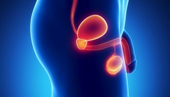 Identifican nuevo subtipo de cáncer de próstata hormonoresistente