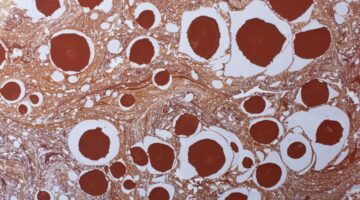 Inmunoterapia en el melanoma: un nuevo horizonte de esperanza a largo plazo