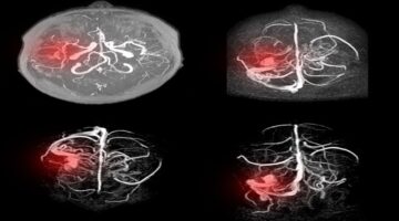 Inteligencia Artificial ayudaría a detectar aneurismas cerebrales