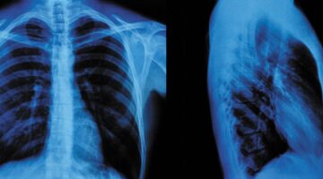 Inteligencia Artificial en radiología: ¿una herramienta confiable para excluir patologías en radiografías de tórax?