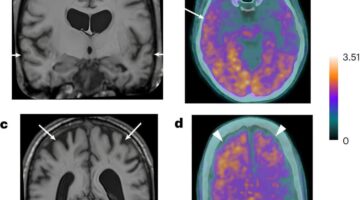 Investigadores descubren casos de enfermedad de Alzheimer adquirida