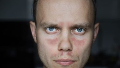 Lupus: la enfermedad autoinmunitaria que afecta a millones en todo el mundo