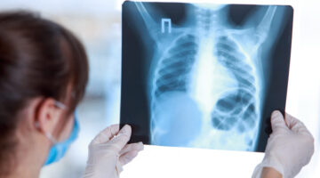 La OMS emite nuevas recomendaciones para tratar la tuberculosis en niños y jóvenes