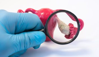 Las diferentes supervivencias en cáncer de ovario