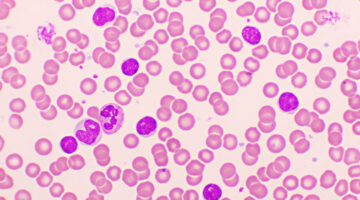 Leucemia linfocítica crónica ¿cambiará el paradigma del tratamiento en Colombia