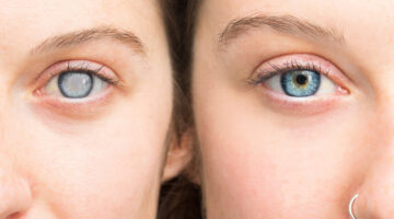 Lo que debes saber sobre el Glaucoma