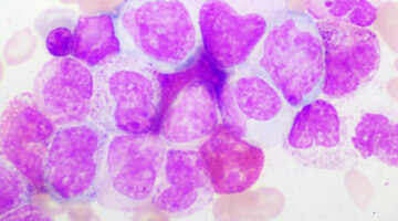 Lo que debes saber sobre la leucemia mieloide crónica (LMC)