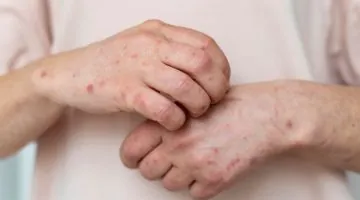 Lupus eritematoso sistémico en Colombia desafíos clínicos y barreras en la atención integral