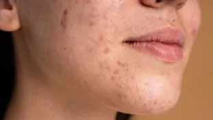 Lupus la urgencia de diagnosticar a tiempo una enfermedad silenciosa y devastadora