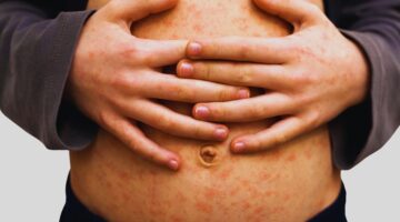 MINSA monitorea 34 posibles casos de sarampión