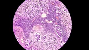 Método podría incrementar detección de cánceres de difíciles tratamiento