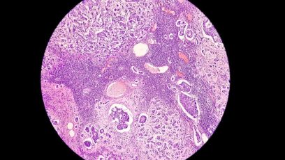 Método podría incrementar detección de cánceres de difíciles tratamiento