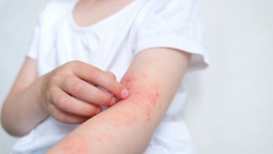 México: Llamado para evitar la automedicación en dermatitis atópica en infancias y adolescencias