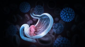 Modelo predictivo optimiza tratamiento del cáncer gástrico