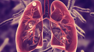 Nuevas metas para poner fin a la tuberculosis en el mundo