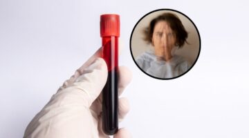 Nuevo test sanguíneo podría revolucionar el diagnóstico temprano de la esquizofrenia