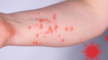 OMS reporta disminución de casos de viruela símica