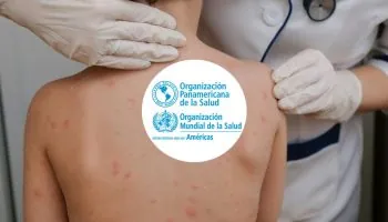OPS alerta sobre la pérdida del estatus de eliminación del sarampión en las Américas y pide reforzar la vacunación
