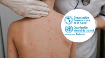 Aumento de sarampión en las Américas en 2025