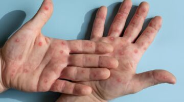 OPS lanza alerta sanitaria por nuevo caso de mpox en EE.UU.