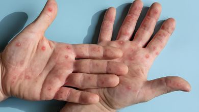 OPS lanza alerta sanitaria por nuevo caso de mpox en EE.UU.