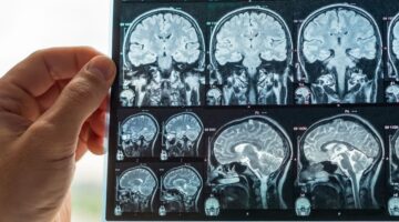 Rayos x tridimensionales podrian detectar enfermedad neurodegenerativa