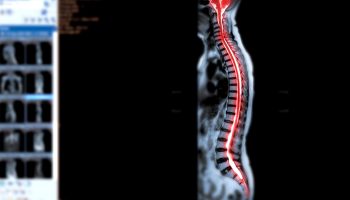 Reactivan los nervios de la médula espinal de paciente con enfermedad neurodegenerativa