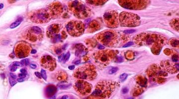 Revelan desacierto en el enfoque de terapia celular con macrófagos