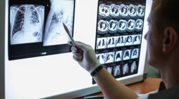 Riesgo de mortalidad por EPOC podría predecirse con un TAC de tórax